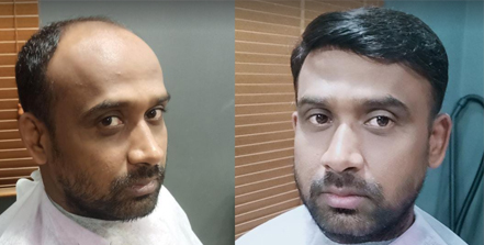 Mk hair fixing non surgical hair transplant