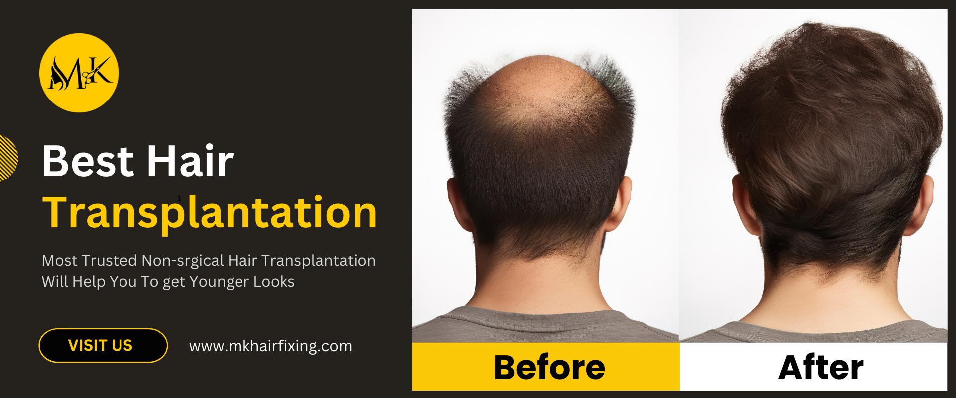 Mk hair fixing non surgical hair transplant
